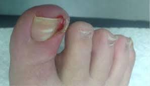 ingrown nails southwest foot ankle