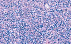 Image result for Ewing Sarcoma