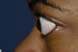 Image result for Proptosis