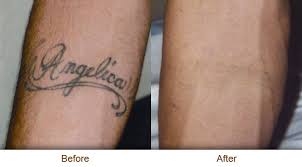 These are much more natural remedies. How To Do Tattoo Removal At Home Karoltats