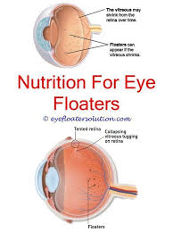 Will Stress Cause Eye Floaters What Causes Eye Floaters How Do Eye Floaters Form Premacular Bursa E Eye Floaters Causes Floaters Eye Laser Treatment For Eyes
