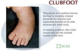 Image result for Clubfoot