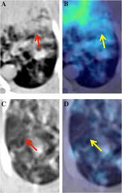 We did not find results for: A Computational Pipeline For Quantification Of Pulmonary Infections In Small Animal Models Using Serial Pet Ct Imaging Ejnmmi Research Full Text