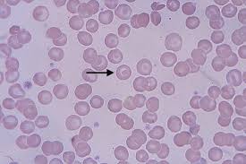 An abnormal red blood cell with a ringed appearance, associated with some anemias. Peripheral Smear In Case Of Thalassemia Target Cell Is Indicated By An Download Scientific Diagram