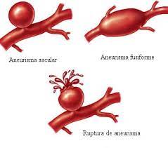 .aneurisma cerebral, el equipo de expertos de ui health en el centro para aneurismas cerebrales evaluarán todas las opciones disponibles para desarrollar el mejor plan de tratamiento para usted. Tratamiento De Aneurisma Cerebral En Monterrey Dr Primo Delgado