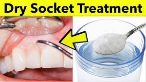 How can i get rid of or help dry socket? How To Treat Dry Socket After Tooth Extraction Natural Dry Socket Treatment At Home Youtube