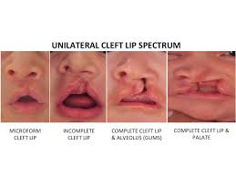 Image result for Cleft Lip