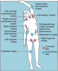 Lymph Node Sites For Hodgkin S Disease Lymphatic System Lymph Massage Medical Knowledge