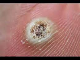 Foot care after a plantar wart removal. Death Of A Wart Timelapse Youtube