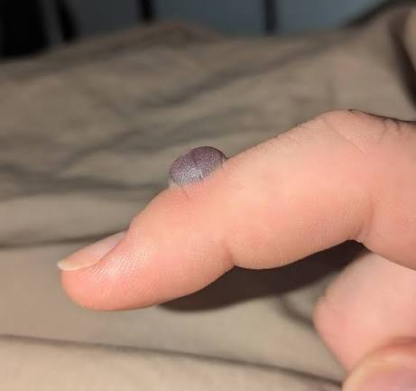 Painful blister after wart cryotherapy treatment