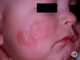 Image result for ekzema face