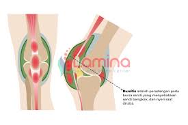 Check spelling or type a new query. Bursitis Adalah Penyakit Penyebab Lutut Anda Sakit Klinik Patella