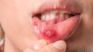 It looks like a giant canker sore but a canker sore is caused by a virus and will eventually go away. Canker Sore On Lip Causes Risk Factors And Treatment