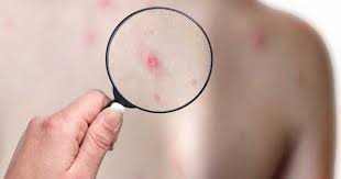 Aparece como pequeñas manchas rojas y vesículas llenas de líquido o pus, o costras. Culebrilla La Hermana Menor De La Varicela Conocela Y Aprende A Identificarla Clikisalud Net Fundacion Carlos Slim