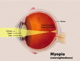 Near Sightedness Wikipedia