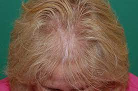 Incredibly knowledgeable and makes sure you completely understand and are aware of what you want. Hair Loss Treatment For Women Chicago Il Chicago Hair Institute