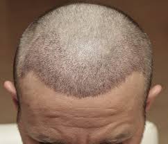 Die beiden hauptmethoden zur haartransplantation, die fut und die fue, überzeugen mit einer bis zu wann ist eine haartransplantation sinnvoll? Verlauf Der Haartransplantation Im Uberblick Health Travels