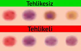 cocuklarda gorulen normal ve anormal morluklar bilgiustam