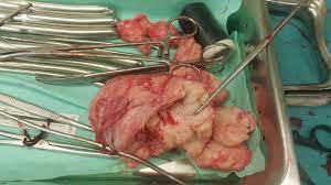 Ia dijalankan untuk merawat neuralgia trigeminal apabila araf trigeminal dikomprei oleh arteri. Fibroid Wanita Tanpa Rahim