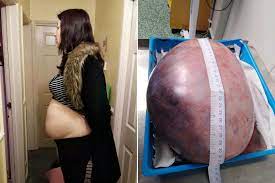 Here's my story about having removal surgery while 15 weeks pregnant. Woman Has Massive Ovarian Cyst Removed I Feel So Much Lighter