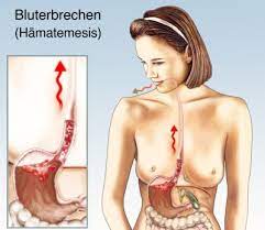 Erbrechen Mit Blut Ursachen Behandlung Vorbeugung Gesundpedia De