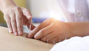 Who Should Use Acupuncture For Chronic Back Pain