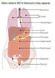 Neuroendocrine The Little Suckers Get Everywhere Ronny Allan Living With Neuroendocrine Cancer Carcinoid Cancer Awareness Neuroendocrine Cancer Carcinoid Cancer