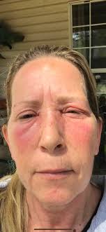 How to get rid of gnats in Georgia?