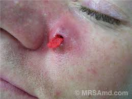Pubic hair also signs and symptoms of hair loss may include: Mrsa Pictures Staph Infection Pictures Graphic Images Mrsa Md