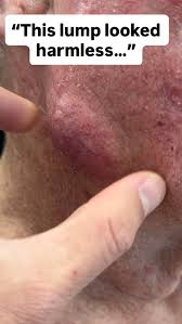 Image result for skin cancer on nose pimple