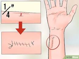 How do you know if you need stitches? How To Determine If A Cut Needs Stitches 9 Steps With Pictures