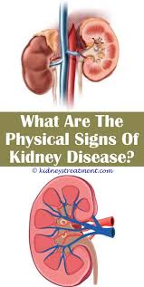 Pin On Kidney Disease Diet
