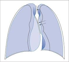 Us scan they can be identified clearly and it is very complicated.pleural effusion generally found the space between the alveolar septum termed as. Pleura Radiology Key