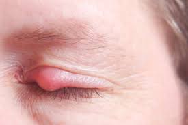 Orzuelo Causas Remedios Para Su Tratamiento Blog De Clinica Baviera