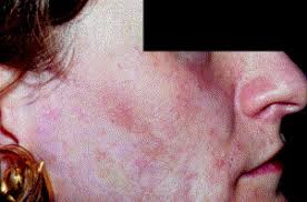 Image result for Postinflammatory Hypopigmentation