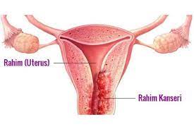 Merhaba 35 yaşındayım.bana 2 sene önce rahim kanseri teşhisi konuldu ve rahmim alındı. Rahim Agzi Kanseri Hpv Nedir Izmir Ozel Park Tip Merkezi