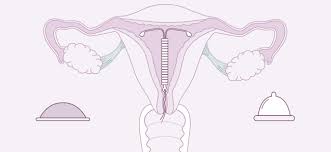 Avantages et effets secondaires du stérilet hormonal. Bien Choisir Sa Contraception Sans Hormones Blog De Bivea