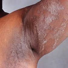 Peeling skin syndrome (pss) refers to a group of conditions that causes skin to peel and tear easily. What Is Yeast Infection On Skin Peeling Zanr Lavanda Galery Ru
