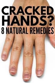 Severely Cracked Hands 8 Tips Remedies For Fast Relief Dry Cracked Hands Extremely Dry Hands Cracked Hands