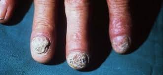 Image result for Candidiasis