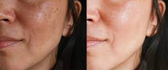 Los 4 Mejores Aceites Naturales Para Eliminar Las Manchas De La Cara La Opinion
