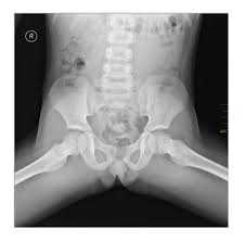 Image result for Hip XRay