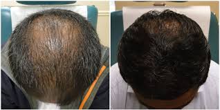 Prp before and after hair treatments to test the efficacy of prp for hair loss, doctors conducted a hair pull test on a group of random patients. Experts Debate Does Platelet Rich Plasma Therapy Work For Hair Loss
