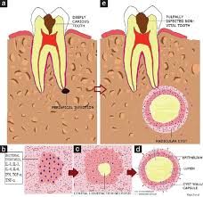 Radicular Cyst Of The Anterior Maxilla An Insight Into The Most Common Inflammatory Cyst Of The Jaws Koju S Chaurasia Nk Marla V Niroula D Poudel P J Dent Res Rev