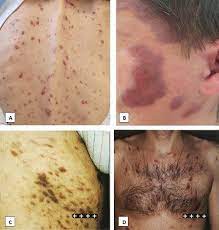Survival rates for kaposi sarcoma. Kaposi Sarcoma Disseminated Cutaneous Involvement A B Images From Download Scientific Diagram
