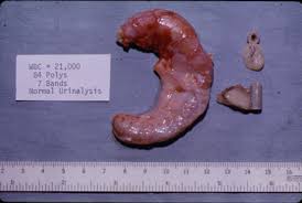 Image result for Appendicitis