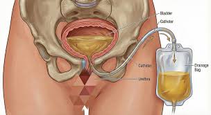 urinary catheterization procedure