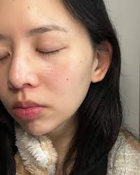 Ilso Natural Mild Clear Nose Patch: The Viral K-Beauty Mask For Blackheads