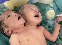 Indore:इंदौर में जन्मी दो सिर वाली बच्ची की मौत,17 दिन पहले लिया था जन्म
