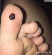 как вывести сухой мозоль со стержнем на пальце ноги Lazernoe Udalenie Mozoli So Sterzhnem Ne Dlya Slabonervnyh Nepriyatno Bolno Dorogo Dolgo A Dejstvenno Polnyj Otchet Otzyvy Pokupatelej